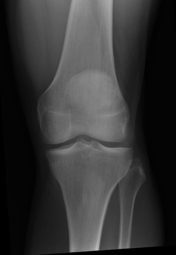 X-ray left knee